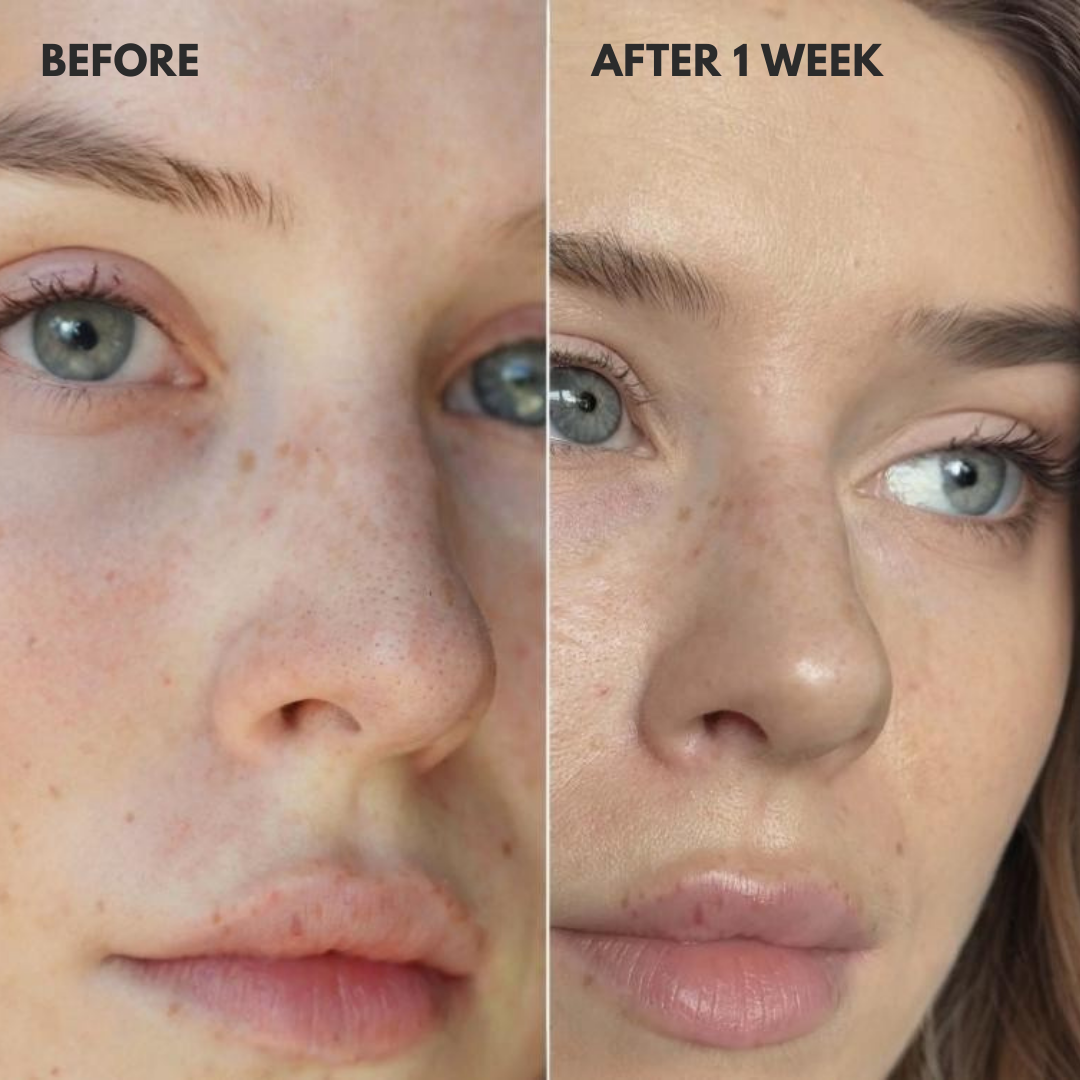 Veglow™ Nose Patches